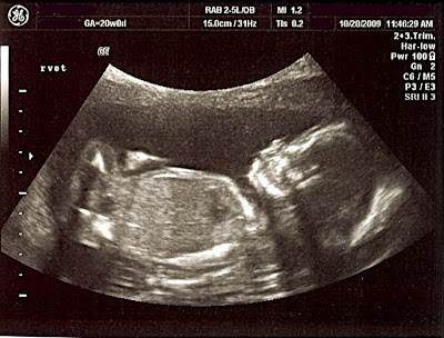 3d ultrasound pictures at 26 weeks. 3d Ultrasound Pictures 20