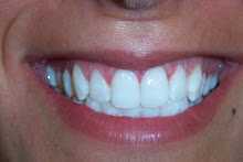 Blanqueamiento dental