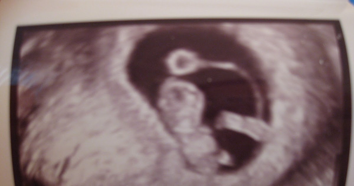 Life of Baby Second Sonogram 9 weeks