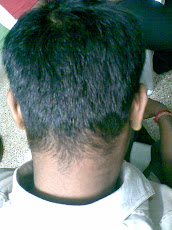 Alopecia Areate- AfterTreatment