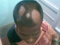 Alopecia Areate- Undergoing Treatment