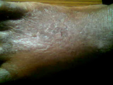 Eczema- During Treatment