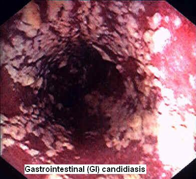 Pictures Of Infections