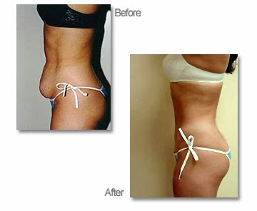 Abdominoplasty Recovery
