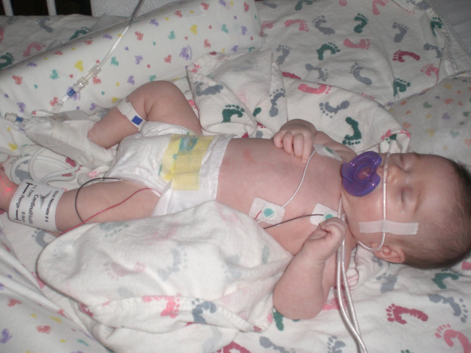 Rsv Bronchiolitis