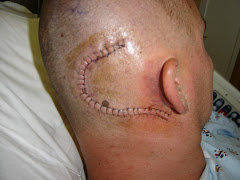 The Baseball Stitches