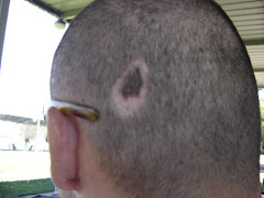 Mark on my head from where the prongs were that held my head still during surgery. Bald spot now.