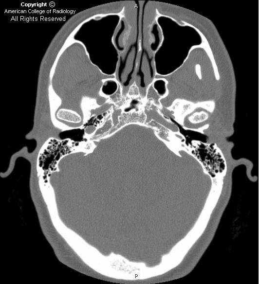 Neuroradiology On the Net Enlarged vestibular aqueduct