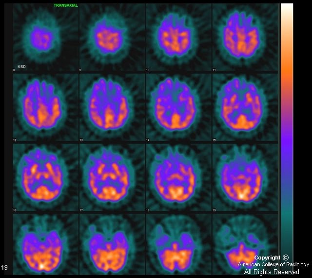 Neuroradiology On the Net Pick's disease
