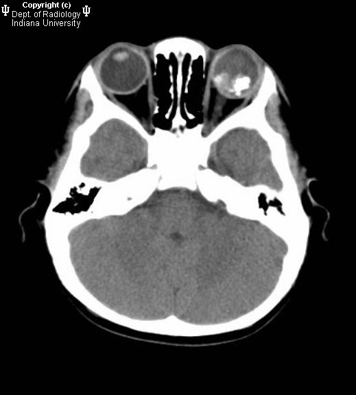 Neuroradiology On the Net Retinoblastoma