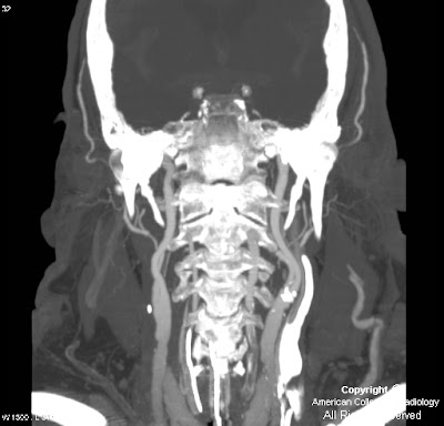 brain death ct angiography radiopaedia
