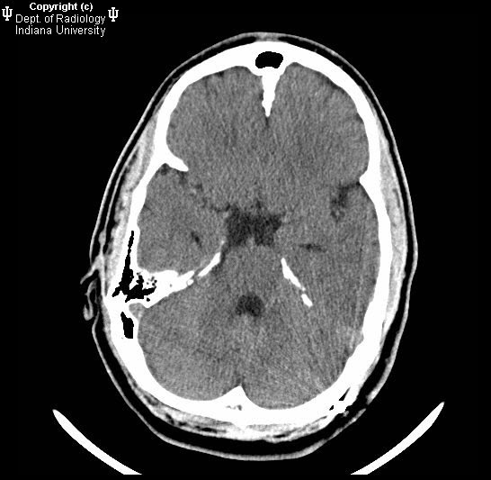 Neuroradiology On the Net GorlinGoltz syndrome