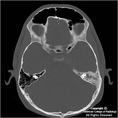 Neuroradiology On the Net: Skull base Langerhans cell histiocytosis (LCH)