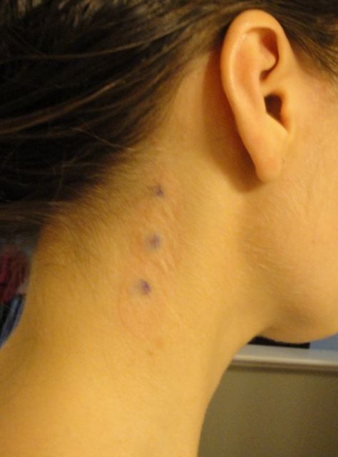 What Can Ibuprofen Overdose Do To You? -.