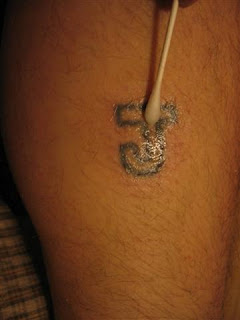 tca peel to remove tattoo happy 2007 more peeling tca peel to remove tattoo happy 2007 more peeling