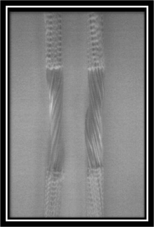 Lars Knee Reconstruction