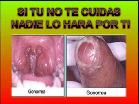 La operación de la desaparición el bridón cerca del pene