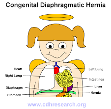 Congenital Diaphragmatic Hernia