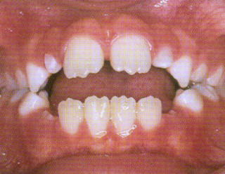 Open Bite