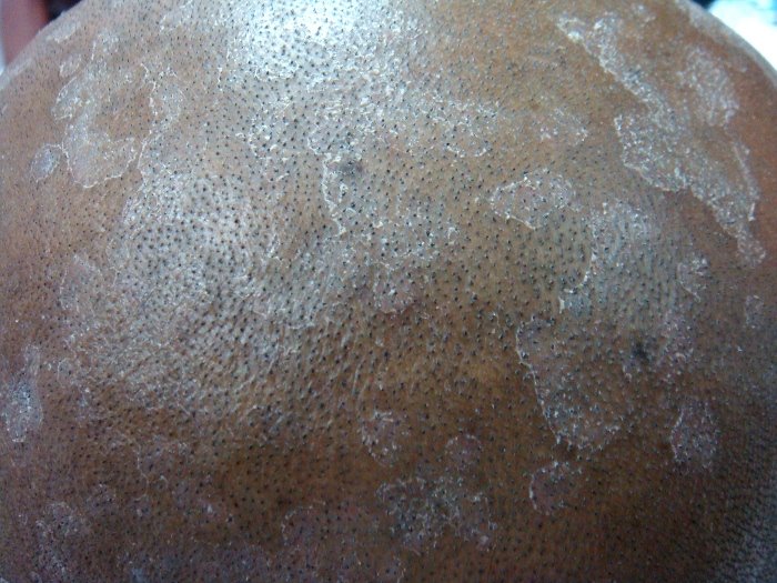 [severe_dandruff.JPG]