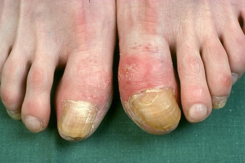 Fair Queens Onychogryphosis (Thickened nails)