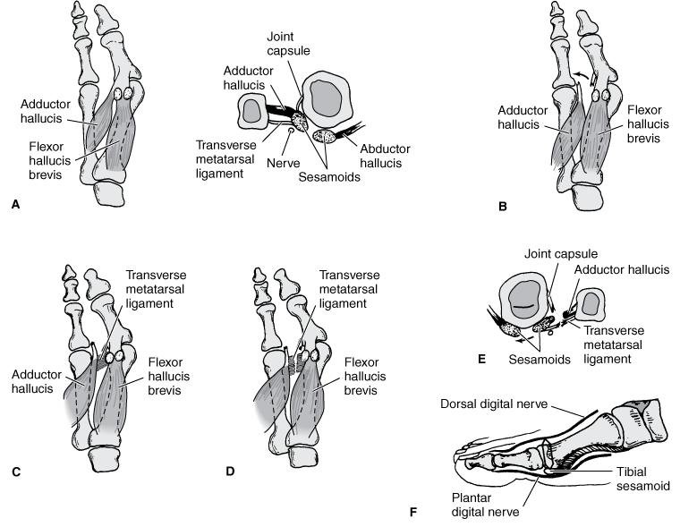 This physiotherapist's blog 大拇指外翻 hallus valgus
