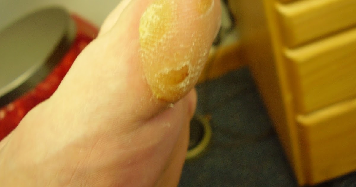 Advanced Foot And Ankle Associates Got A Callus And Not Sure What Is