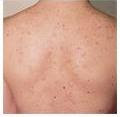 Back Acne Home Remedy
