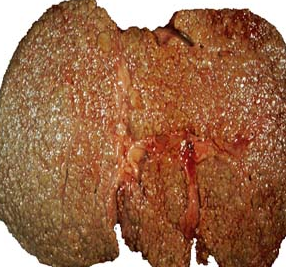 Prevent Liver Cancer with early screening