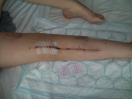 My scar!!! Gory or what!!!
