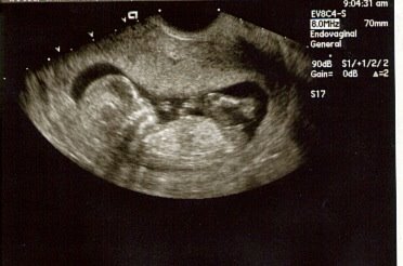 14 Week Ultrasound