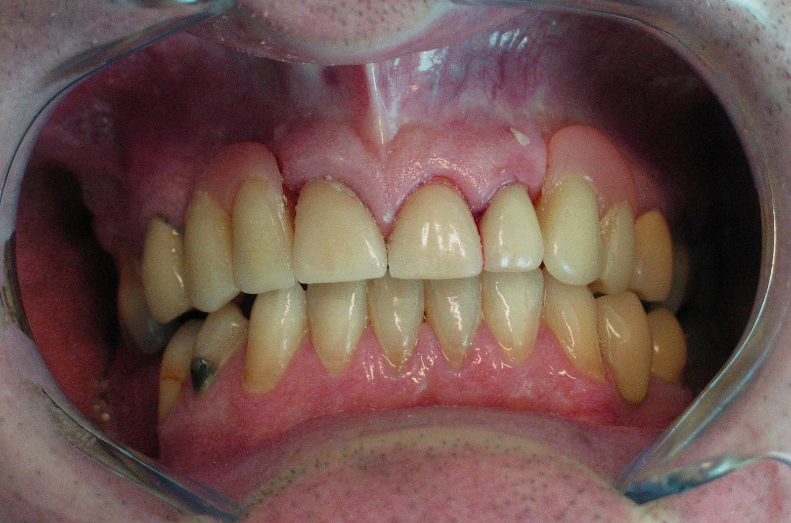 Jonathan's Blog. Life and dentistry combined!: Let me show you some of my dental work. Some ...
