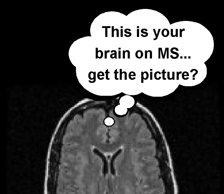 BRAINCHEESE Your Brain On MS...