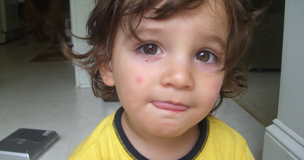 jungle life pictures mosquito bites infections