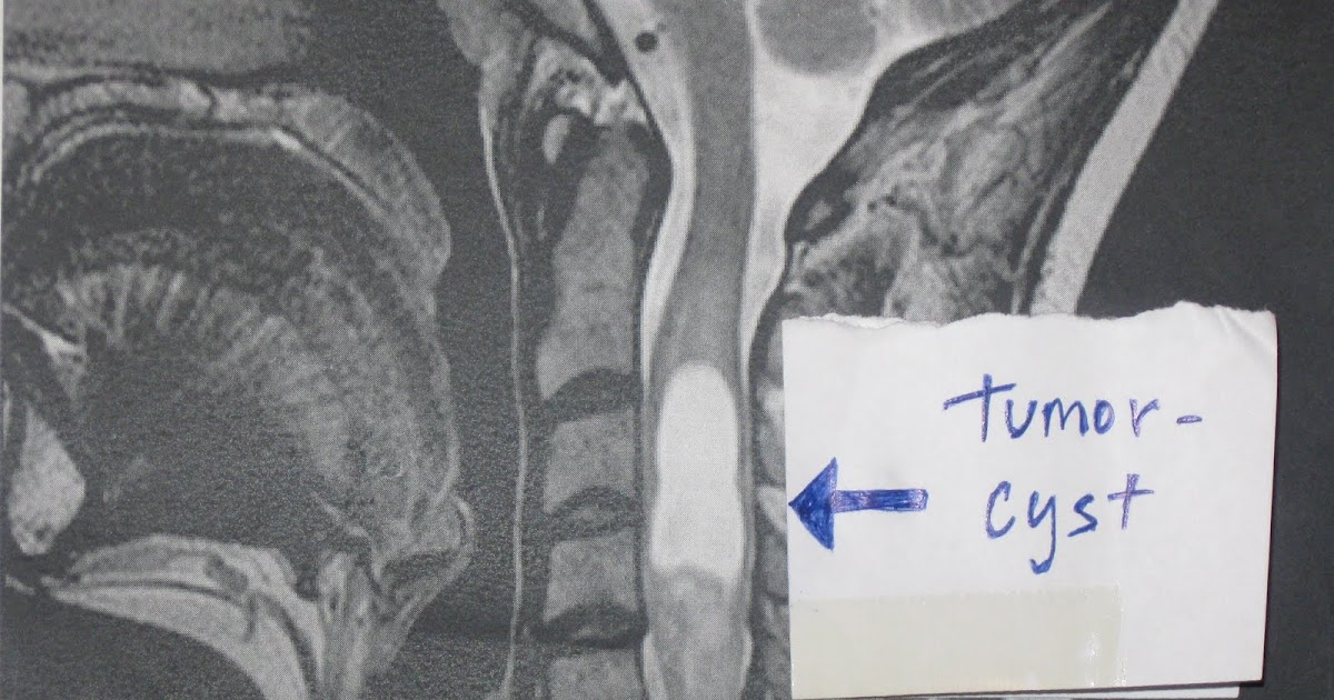 Life Redefined The Tumor Before and After and my neck Hardware!