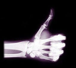 Xray%2BThumbs%2BUp.jpg_thumb.jpg
