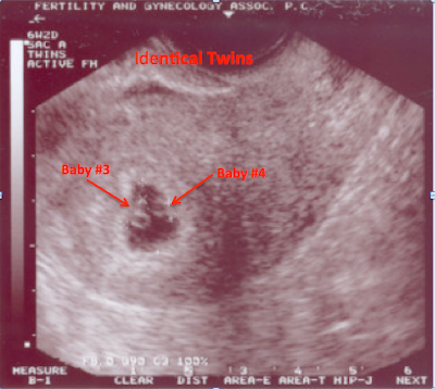 Scans Of Twins. Ultrasound+scan+twins
