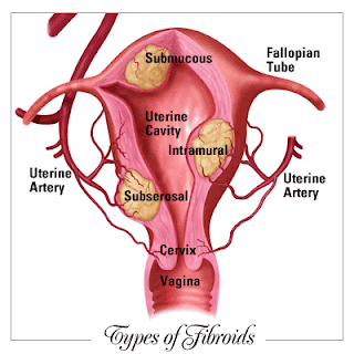 do fibroids cause infertility fibroids are common benign tumors of ...