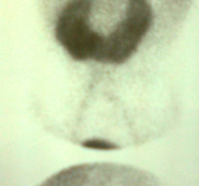 ummara shares HORSE SHOE KIDNEY on DMSA scan.