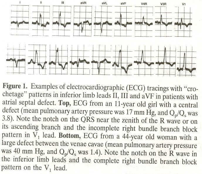 Pedi cardiology EKG "Crochetage" & RBBB in ASD