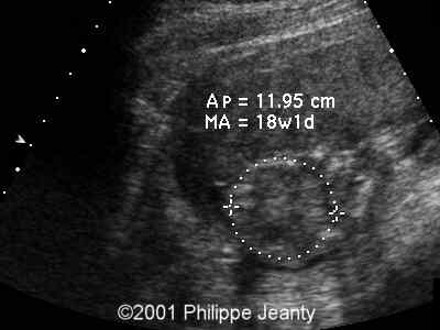 Aneuploidías Trisomía 16