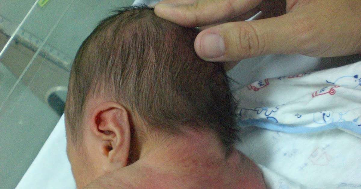 Phimaimedicine: 31. Turner syndrome