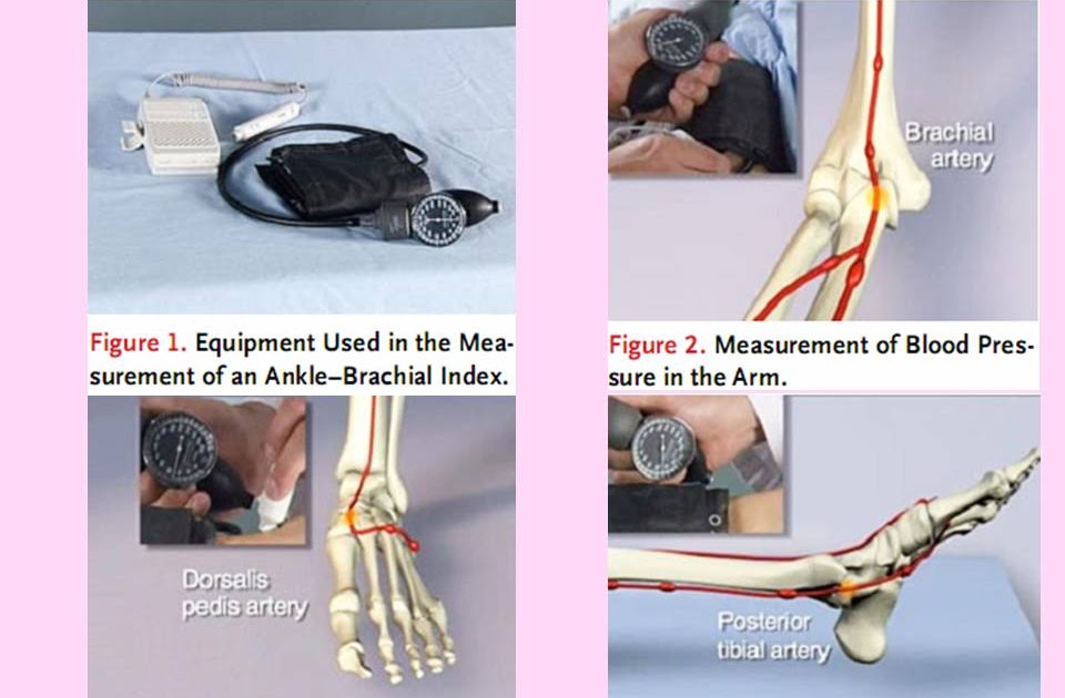 Phimaimedicine 162.AnkleBrachial Index for assessment of peripheral
