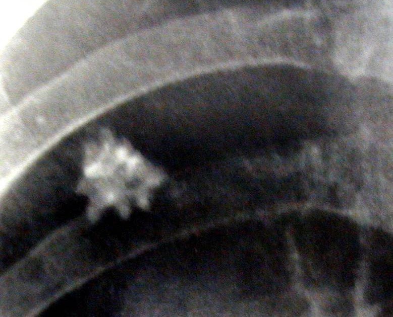 atlas of medicine POPCORN CALCIFICATION