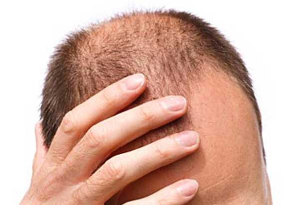 scalp hair loss