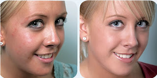 Secrets on How to Clear Sudden Acne Breakouts Quickly