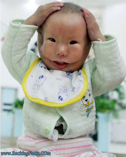 OM BOY BORN WITH A MASKLIKE FACE