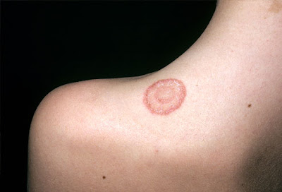 Ringworm Toddler