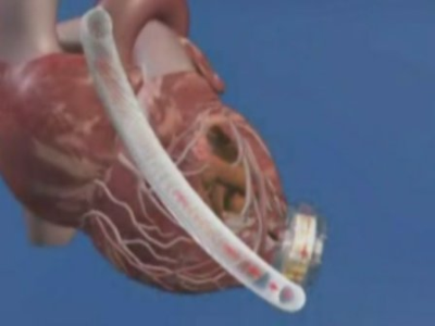 Artificial Heart after Implantation