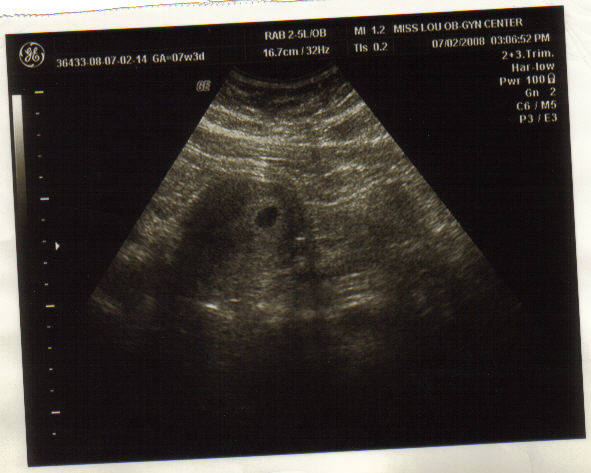 [1st_ultrasound[1]+(2).jpg]
